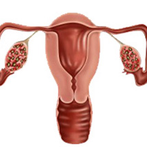 Treatment of PCOS by Diet in Vashi 